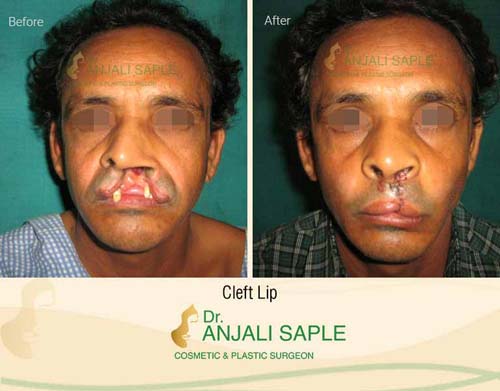 Cleft lip surgery front view case by Dr. Anjali Saple