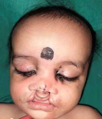 Cleft lip patient story before surgery