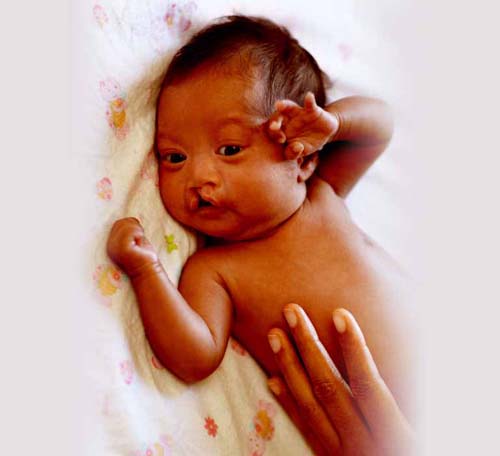 Cleft lip surgery case