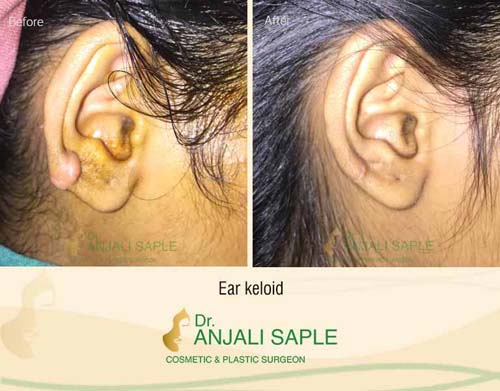 Ear keloid surgery case by Dr. Anjali Saple 1