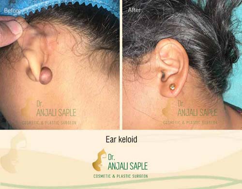 Ear keloid surgery case by Dr. Anjali Saple 10