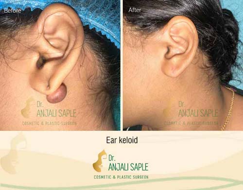 Ear keloid surgery case by Dr. Anjali Saple 10