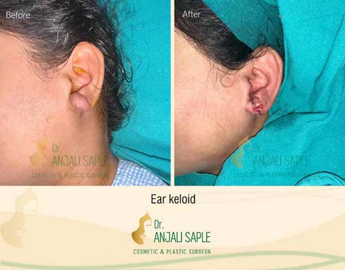 Ear keloid surgery case by Dr. Anjali Saple 11