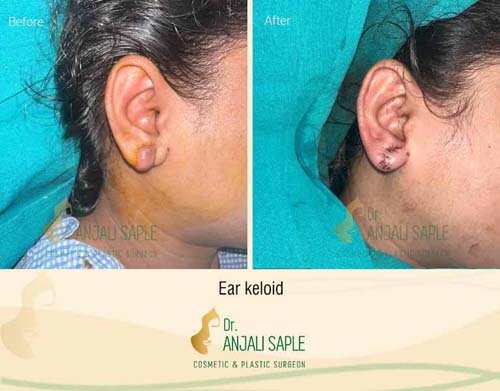 Ear keloid surgery case by Dr. Anjali Saple