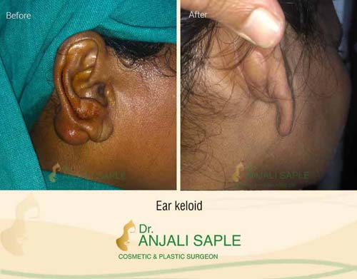 A case of scar management