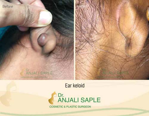 Ear keloid surgery case by Dr. Anjali Saple 3