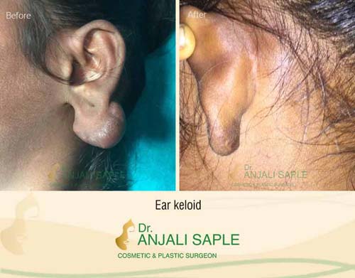 Ear keloid surgery case by Dr. Anjali Saple 3