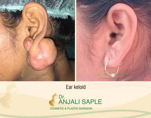 Ear keloid surgery case by Dr. Anjali Saple 4