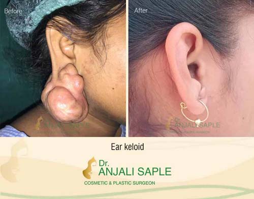 Ear keloid surgery case by Dr. Anjali Saple