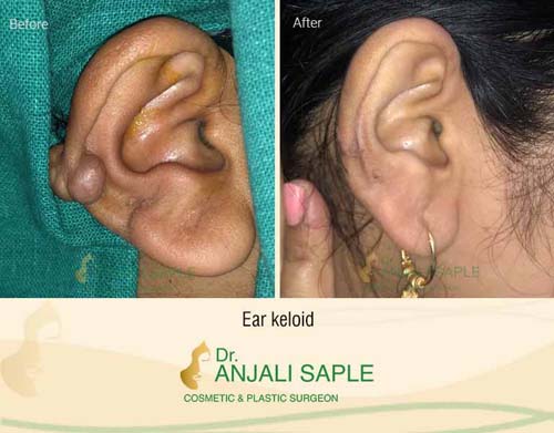 Ear keloid surgery case by Dr. Anjali Saple 5