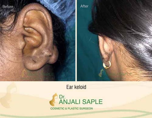 Ear keloid surgery case by Dr. Anjali Saple 6