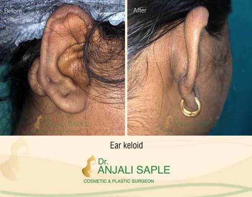 Ear keloid surgery case by Dr. Anjali Saple 6