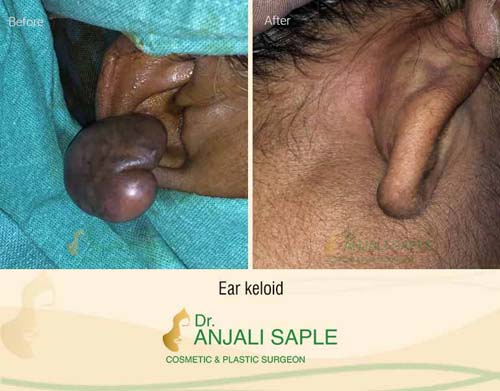 Ear keloid surgery case by Dr. Anjali Saple 7