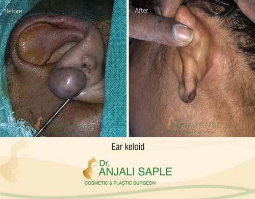 Ear keloid surgery case by Dr. Anjali Saple