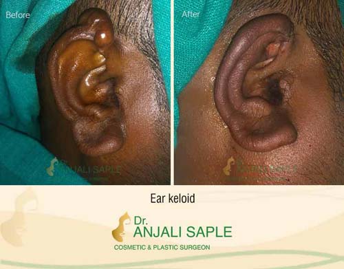 Ear keloid surgery case by Dr. Anjali Saple 8