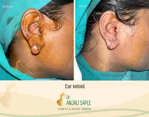 Ear keloid surgery case by Dr. Anjali Saple 9