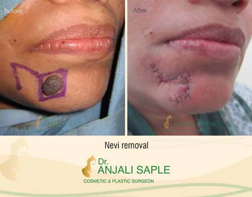 Scars and nevi before and after case by Dr. Anjali Saple