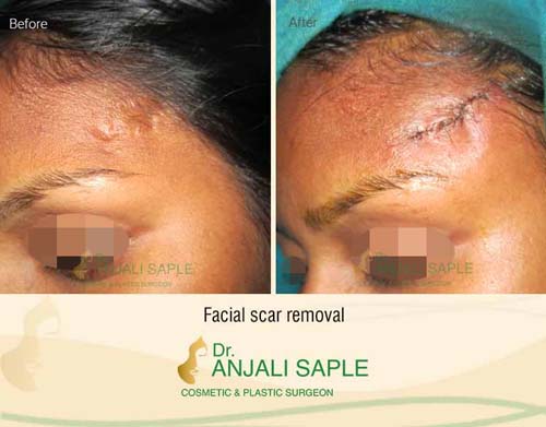 Facial scars surgery case by Dr. Anjali Saple 2