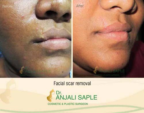 Facial scars surgery case by Dr. Anjali Saple 1