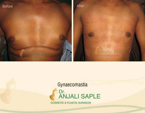 Gynecomastia surgery by Dr. Anjali Saple 1