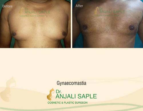 Gynecomastia surgery by Dr. Anjali Saple 10