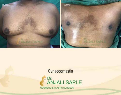 Gynecomastia surgery by Dr. Anjali Saple 11