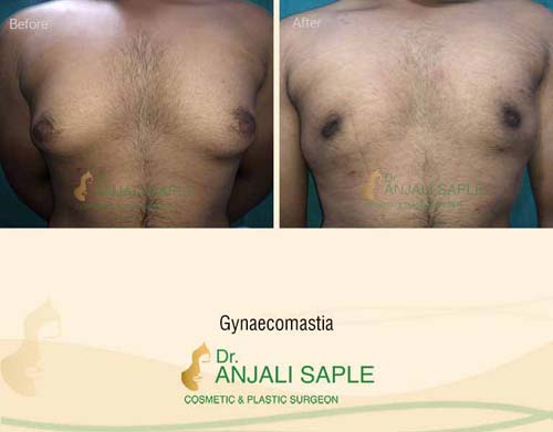 Gynecomastia surgery by Dr. Anjali Saple 12