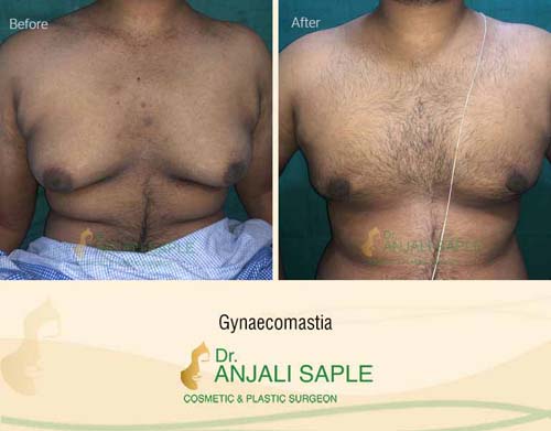 Gynecomastia surgery by Dr. Anjali Saple 13