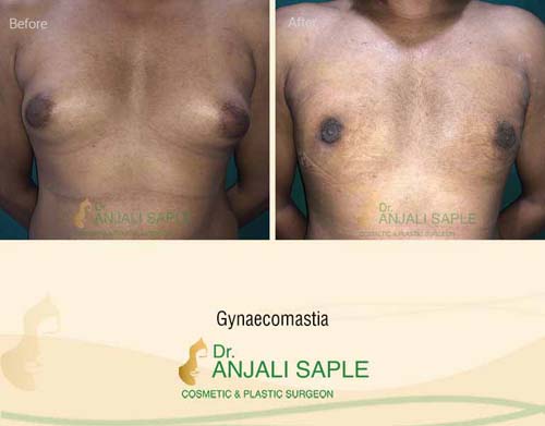 Gynecomastia surgery by Dr. Anjali Saple 14