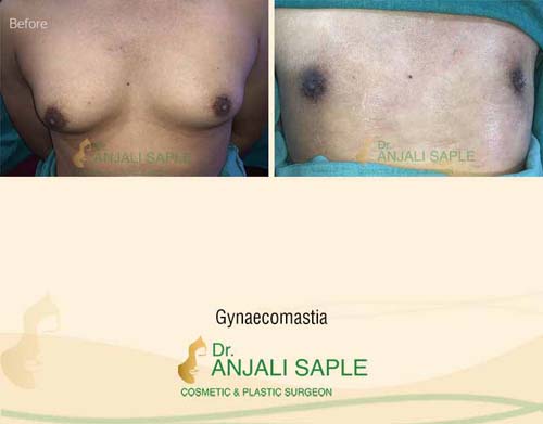 Gynecomastia surgery by Dr. Anjali Saple 15