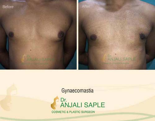 Gynecomastia surgery by Dr. Anjali Saple 16
