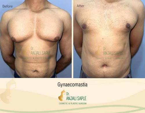 Gynecomastia surgery by Dr. Anjali Saple 17