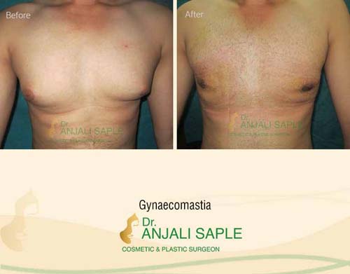 Gynecomastia surgery by Dr. Anjali Saple 2