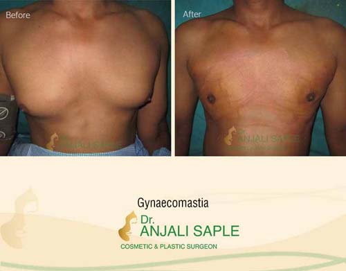 Gynecomastia surgery by Dr. Anjali Saple 3