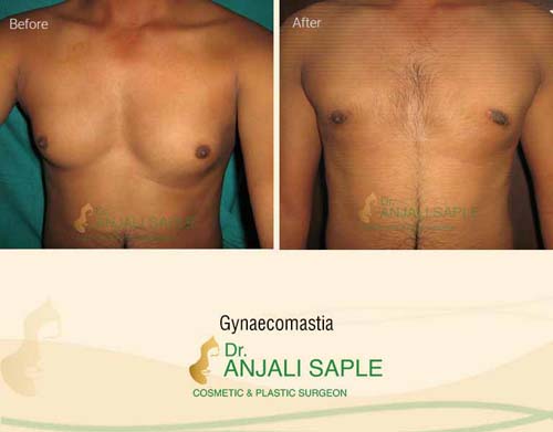 Gynecomastia front view before and after by Dr. Anjali Saple