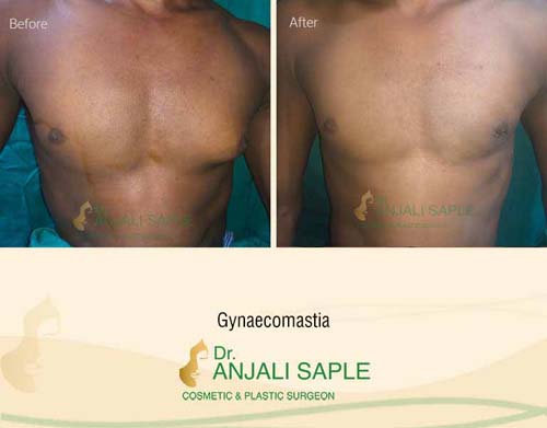 Gynecomastia front view before and after by Dr. Anjali Saple
