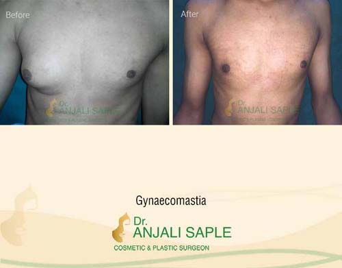 Gynecomastia front view before and after by Dr. Anjali Saple