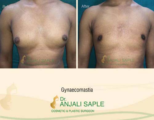 Gynecomastia front view before and after by Dr. Anjali Saple