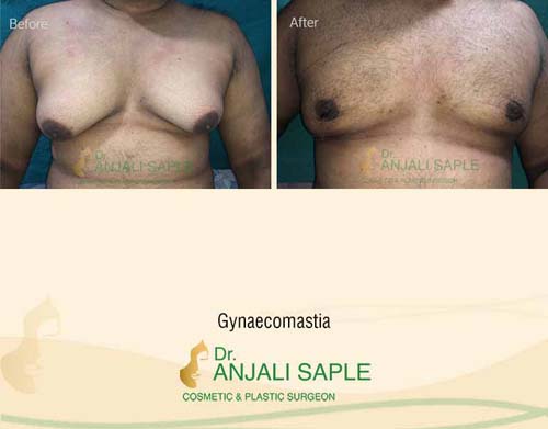 Gynecomastia before and after