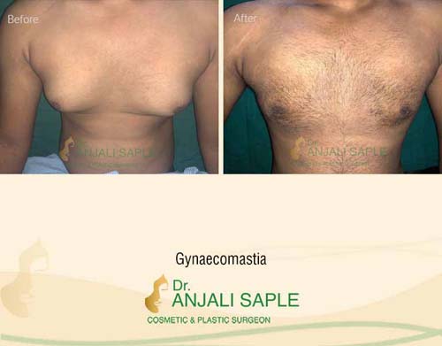Gynecomastia front view before and after by Dr. Anjali Saple