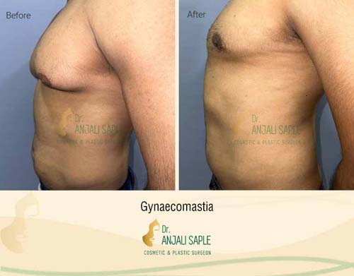 Gynecomastia Before-After Left-side View