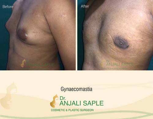 Gynecomastia left view before and after by Dr. Anjali Saple