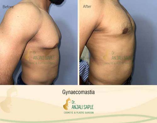 Gynecomastia right side view before and after by Dr. Anjali Saple