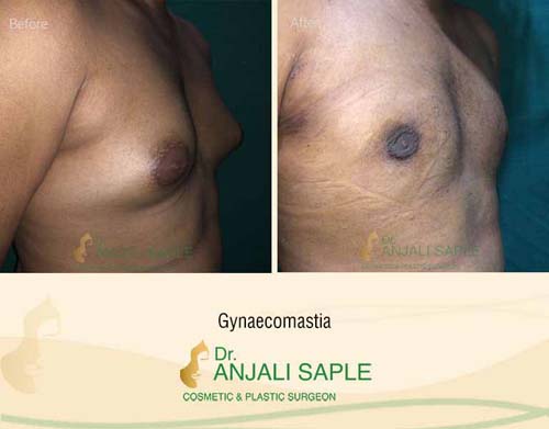 Gynecomastia right view before and after by Dr. Anjali Saple