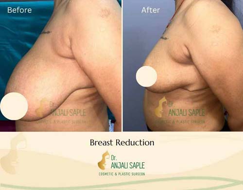 Breast reduction left view before and after by Dr. Anjali Saple