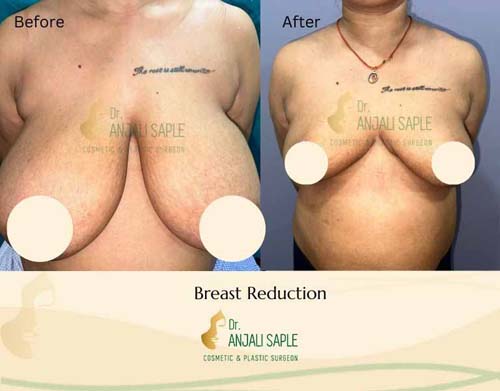 Breast reduction before and after by Dr. Anjali Saple