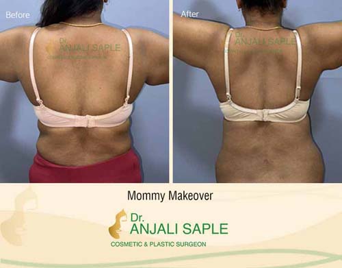 Mommy makeover back view abdomen before and after by Dr. Anjali Saple