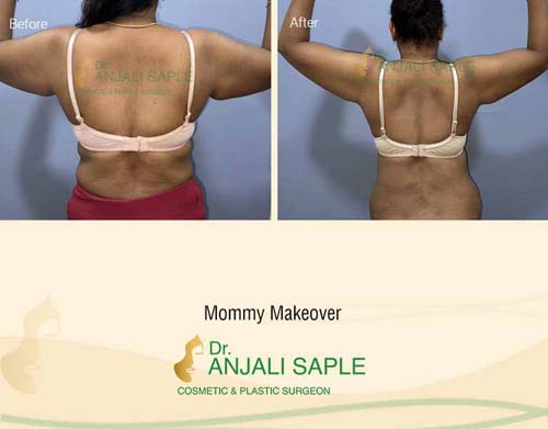 Mommy makeover back view arm liposuction before and after by Dr. Anjali Saple