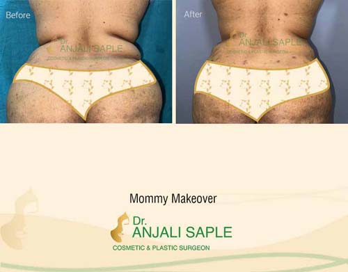 Mommy makeover back view before and after by Dr. Anjali Saple