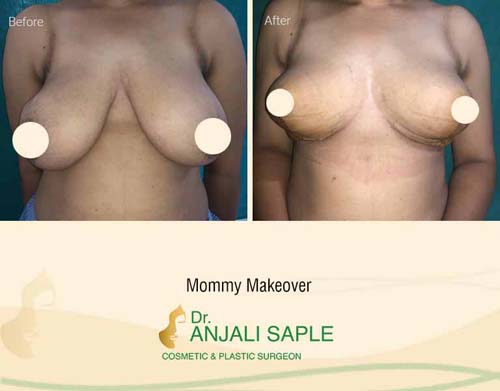 Before-After: Mommy Makeover